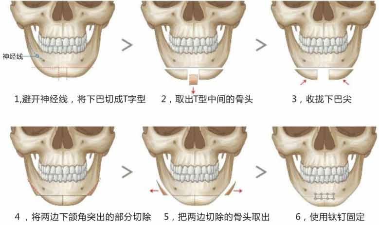 v-line 四方脸整形术